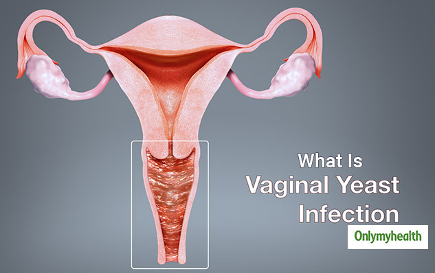 Vaginal Yeast Infection