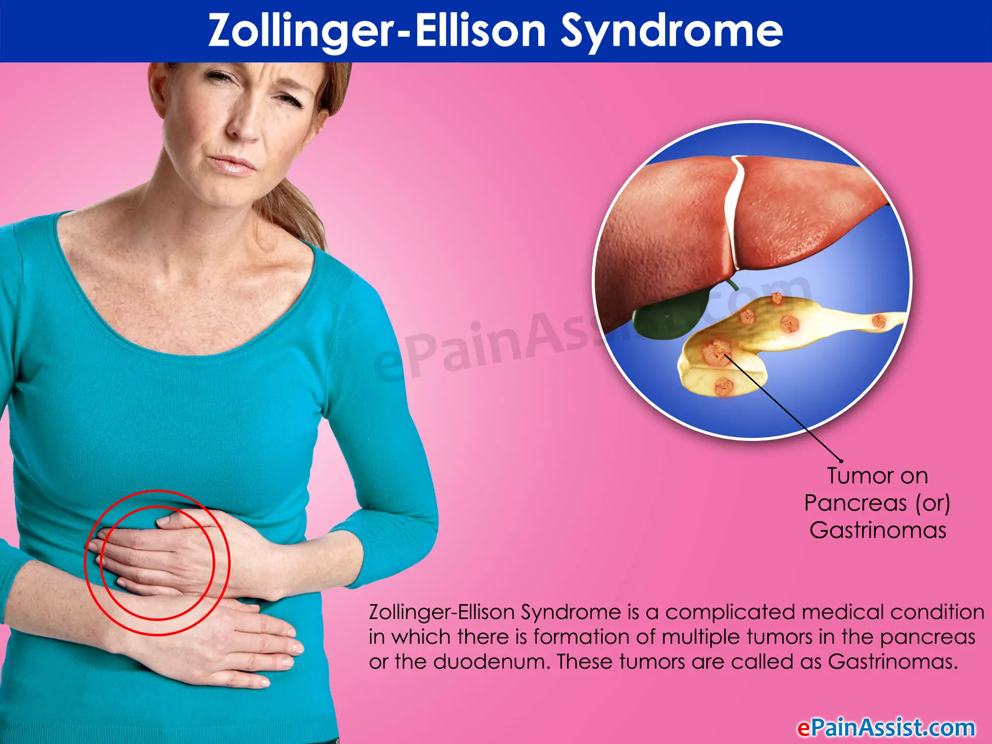 Zollinger-Ellison syndrome